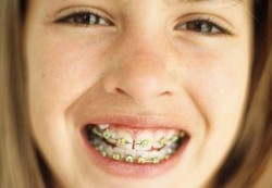 Cara Kawat Gigi Beraksi