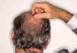 Uban Lebih Menakutkan Dibanding Kebotakan