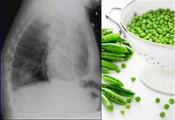 Batuk Tak Sembuh Gara-gara Kacang Polong Tumbuh di Paru-paru