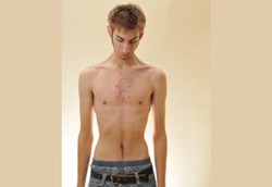 Laki-laki Juga Bisa Kena Anoreksia