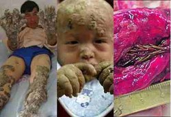 Benda Aneh yang Pernah Tumbuh di Tubuh Manusia 