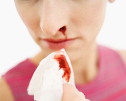 Bahaya Mimisan & Cara Mengatasinya