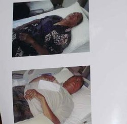 Dokter: Syaukani Stroke Global, Buta, Lumpuh & Tak Bisa Sembuh