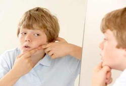 Awas, Obat Jerawat Bisa Bikin Usus Meradang