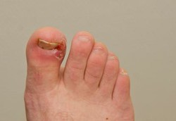 Salah Pilih Sepatu, Kuku Bisa Tumbuh ke Dalam