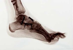 Bau Telur Busuk Bisa Atasi Radang Persendian