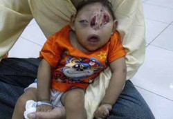 Wajah Tak Sempurna Arjuna Tidak Bisa Dioperasi di RSCM 