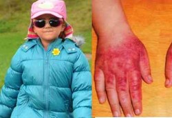 Terkurung Karena Alergi Sinar Matahari