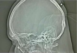 Dikira Kista Ternyata Peluru yang Bersarang di Kepala