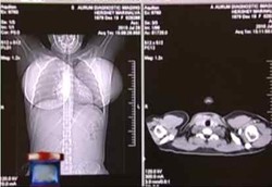 Implan Payudara Terbesar di Dunia Akhirnya Dicopot