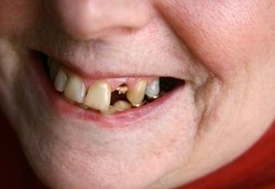 Meski Ompong, Orang Indonesia Merasa Giginya Baik-baik Saja
