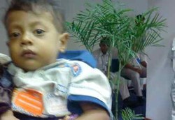 Mahalnya Pengobatan Atresia Bilier