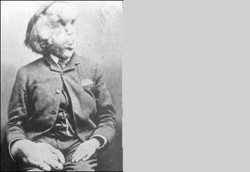 Wajah Seperti Gajah Akibat Sindrom Proteus