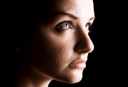 Remaja Kadang Berpikir Ingin Bunuh Diri Gara-gara Jerawat