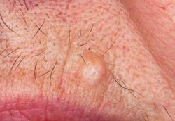 Cairan Nitrogen Efektif Sembuhkan Kutil