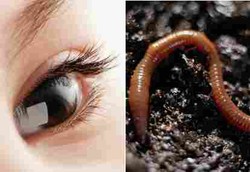 Bintik Aneh di Mata Selama 9 Bulan Tak Tahunya Cacing Giling