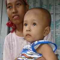 Tak Punya Anus, Balita Asal Bojonegoro Buang Air di Perut