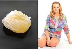 Payudara Meledak Karena Implan Murahan