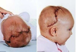 Otak Bayi Dibongkarpasang Agar Tak Rusak Permanen