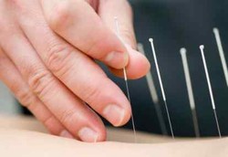 Akupunktur Tak Mempan Pulihkan Kondisi Setelah Stroke 