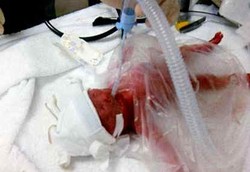 Bayi Prematur Selamat Berkat Kantong Plastik Sandwich