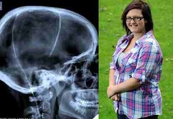 Tak Jadi Buta Setelah Cairan Otak Dialirkan ke Perut