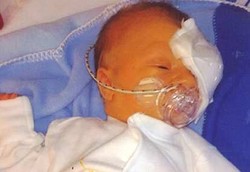 Mata Bayi Copot Karena Kesalahan Penggunaan Forcep