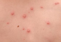 Seberapa Besar Cacar Air Bisa Menular?