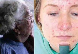 Penyebab Alzheimer dan Jerawat Sama?