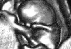 Bayi Sehat Lahir dari Embrio yang Dibekukan 20 Tahun