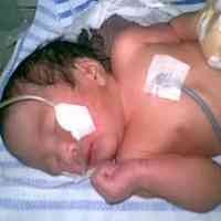 Muncul Benjolan Sebesar Kepala Sejak Lahir