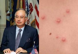 Jika Cacar Air Menulari Kepala Negara 