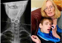 Anak Autis Tetap Hidup Setelah Menelan Gunting Kuku