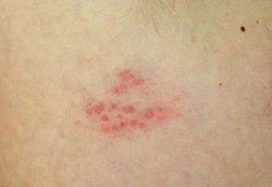 3 Hal yang Membangunkan Virus Herpes