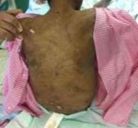 Foto Tunjukkan Kulit Kepala dan Punggung Sumiati Rusak