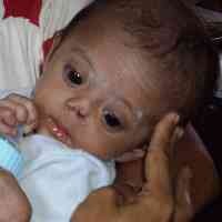 Gara-gara Sering Dimasuki Selang, Lubang Hidung Melati Bengkok