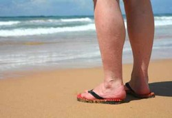 Munculnya Varises di Kaki