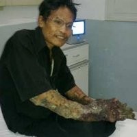 Dede Manusia pohon Ditawari Obat dari Jepang