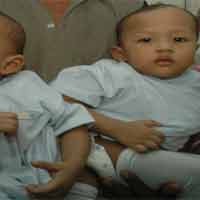 Kembar Siam Dempet Panggul Direncanakan Operasi Akhir Januari