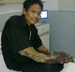 Kutil Kaki Dede Gagal Dikuliti Karena Alat Tak Berfungsi