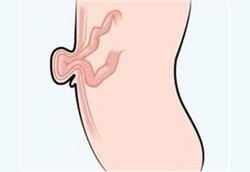 Pusar Ibu Menjuntai Karena Hernia Usai Melahirkan