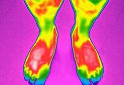 Termometer Pendeteksi Luka untuk Penderita Diabetes