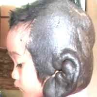 Derita Bocah 7 Tahun Alami Tumor Telinga Hingga Menghitam