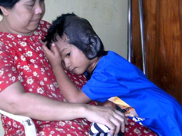 Derita Rizky, Penderita Tumor di Telinga