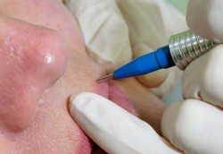 Tato Medis Bukan untuk Gaya-gayaan