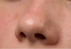 Apa Jadinya Bila Punya Pori-pori Kulit Besar?