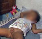 Dokter Urologi: Tak Ada Istilah Anak Disunat Jin