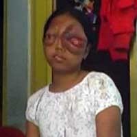 Diana, Penderita Tumor Pada Mata akan Dirawat di Surabaya