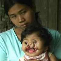 Susah Makan, Balita di Trenggalek Tidak Punya Dinding Mulut 