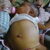 Bayi 5 Bulan Asal Kediri Alami Gangguan Cairan Empedu